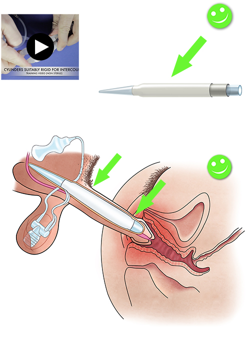 Inflatable Penile Implant ZSI 475 5