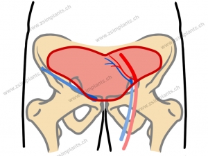 drawing of bird wing abdominal phalloplasty technique