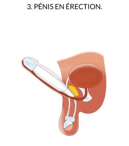 zsi 475 ftm erection