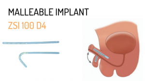 ZSI 100 D4 Metoidioplasty