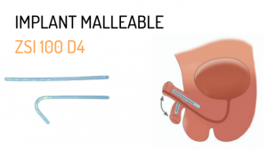 Implant Malleable ZSI 100 D4