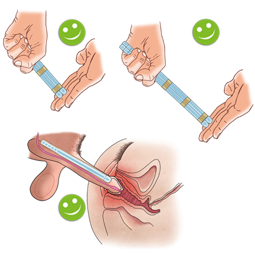 Implantat penis Penuma Implant