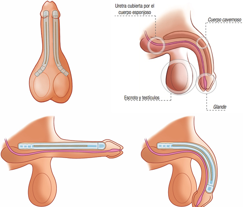 Implantat penis 💉 Penisimplantat: