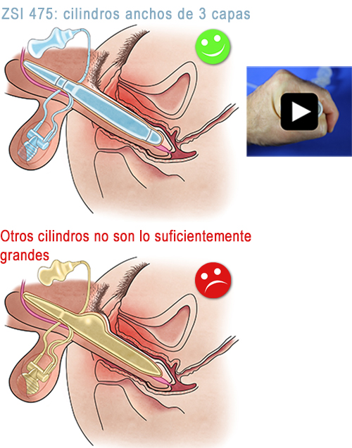 Inflatable Penile Implant ZSI 475 3