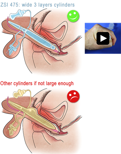 Implant Penien Hydraulique ZSI 475 3
