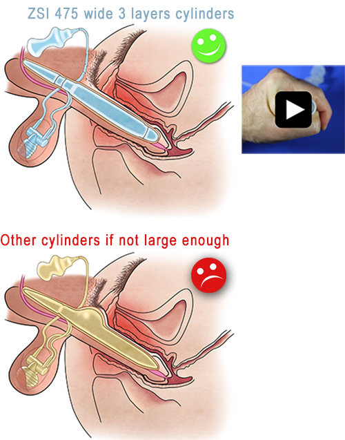 Inflatable Penile Implant ZSI 475 3