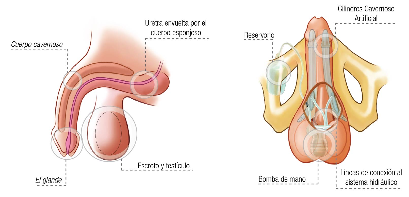 Inflatable Penile Implant ZSI 475