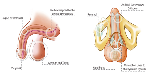 Inflatable Penile Implant ZSI 475