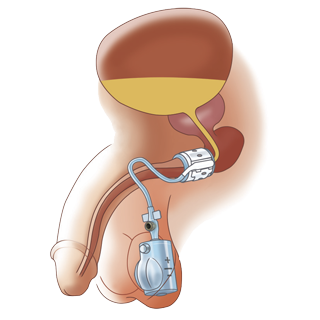 anal Inflatable sphincter indiana artificial anal Inflatable sphincter indiana artificial