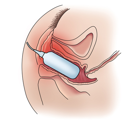 ZSI 200 NS Expansor Vaginal Mujer Cis