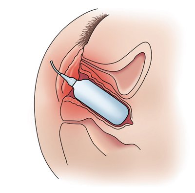 ZSI 200 NS Expander für Trans Frauen