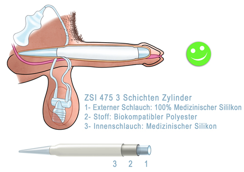 Hydraulische Penisprothese ZSI 475 2