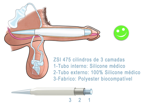 Inflatable Penile Implant ZSI 475 2