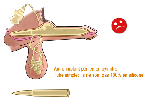 Implant Penien Hydraulique ZSI 475 2